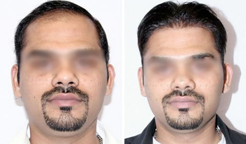 Hair Replacement for Men :: Client PhotosNon-Surgical Hair Replacement,  Cranial Prosthesis, Hair Transplantation
